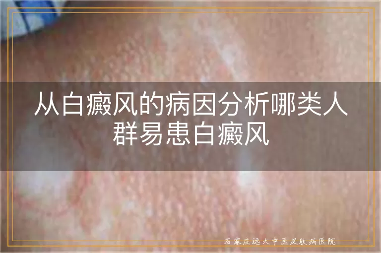 从白癜风的病因分析哪类人群易患白癜风
