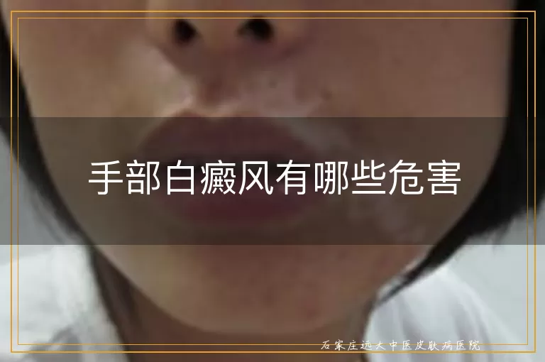手部白癜风有哪些危害