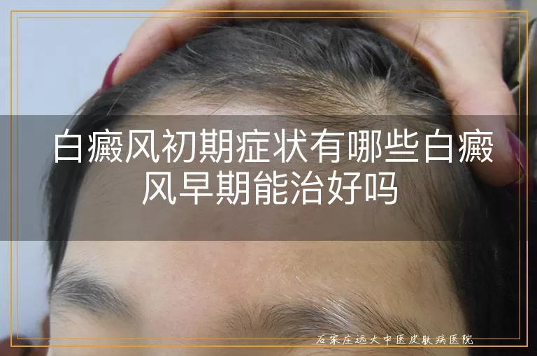 白癜风初期症状有哪些白癜风早期能治好吗