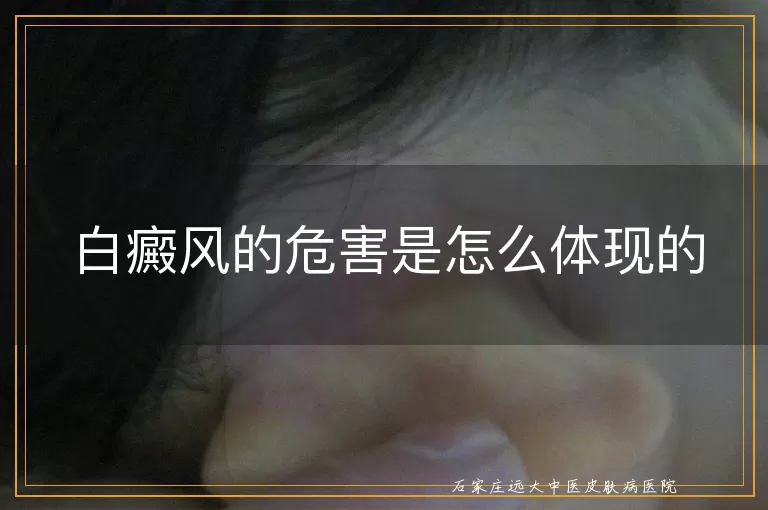 白癜风的危害是怎么体现的
