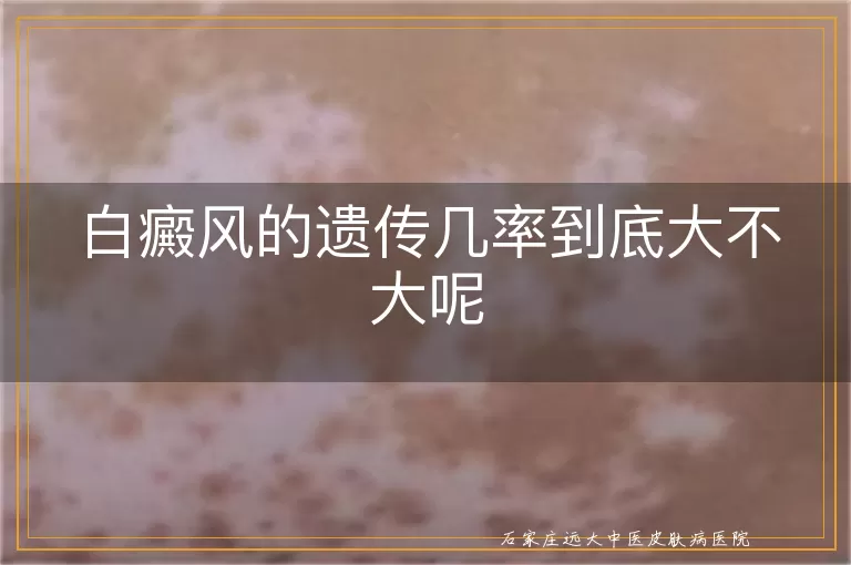 白癜风的遗传几率到底大不大呢