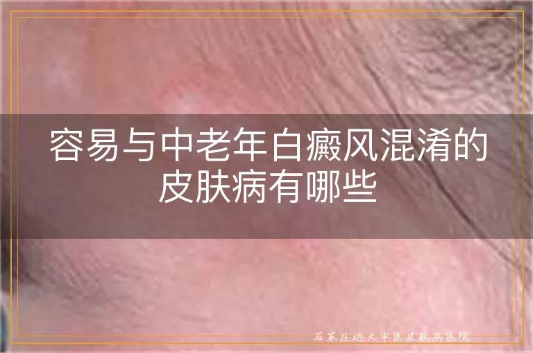 容易与中老年白癜风混淆的皮肤病有哪些