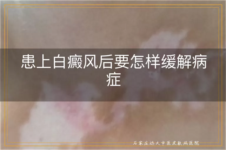 患上白癜风后要怎样缓解病症