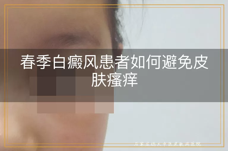 春季白癜风患者如何避免皮肤瘙痒