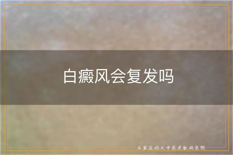 白癜风会复发吗