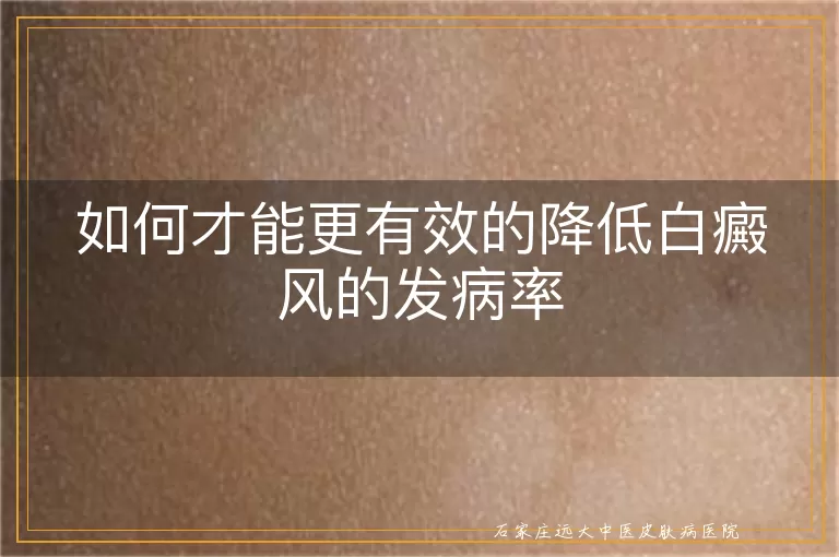 如何才能更有效的降低白癜风的发病率