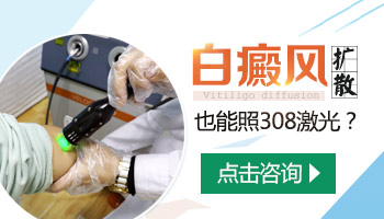 15岁男孩腰部有圆形白斑照uvb治好后复发几率多大