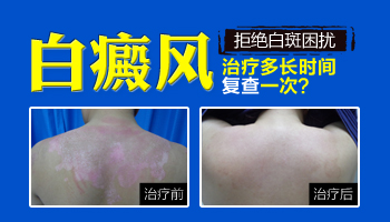 15岁男孩脸部有白斑吃中药治疗需要多久能恢复好