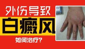 15岁男孩腰部有圆形白斑怎么治疗比较好，用中药可以吗