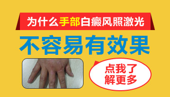 15岁男孩腰部有圆形白斑如何治疗，哪种方法好