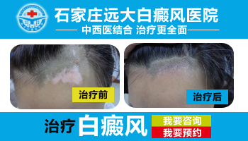 青少年背部有白癜风该怎么治疗，有康复案例吗