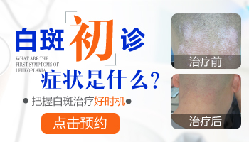 青少年额头长白癜风激光治疗怎么样，多久能康复